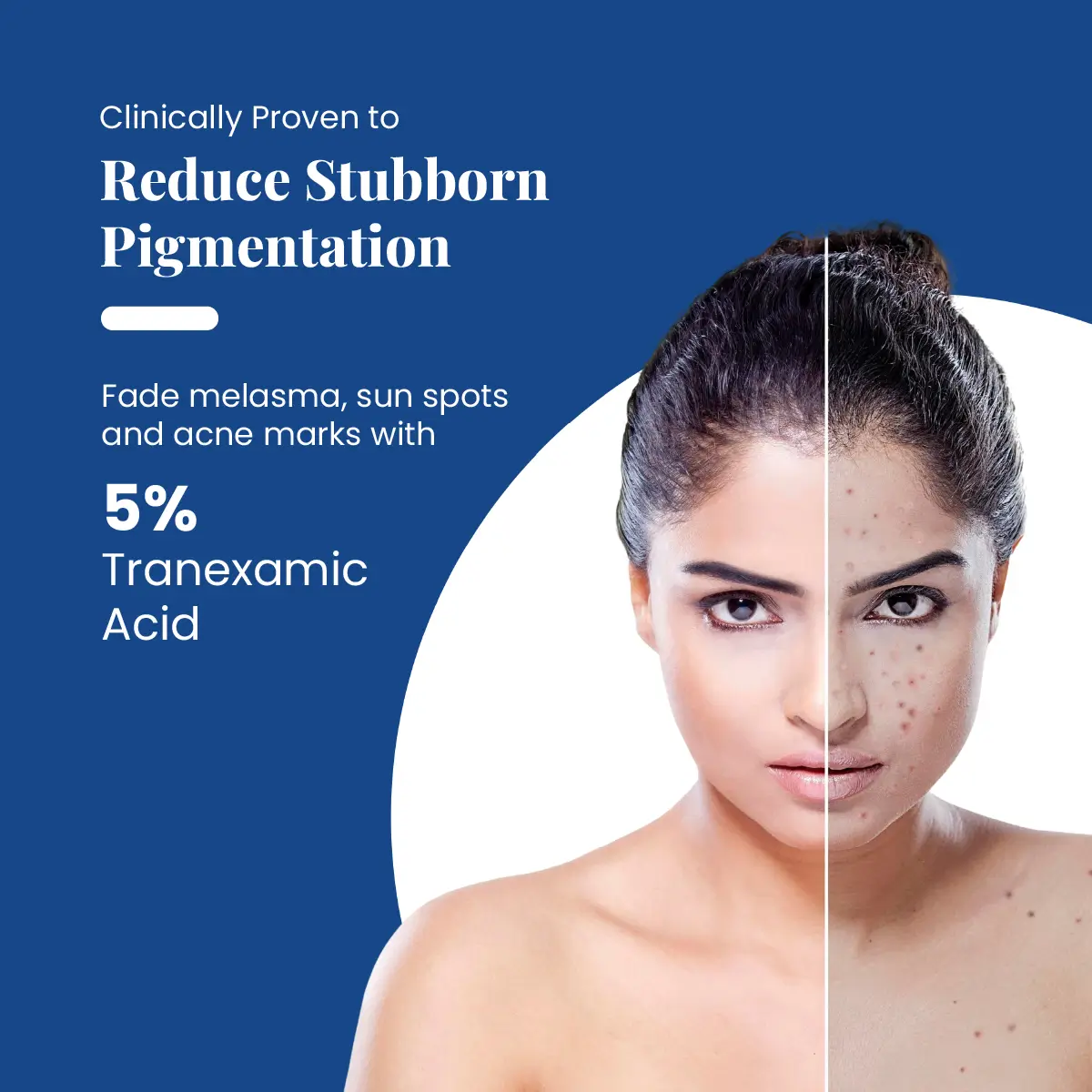 1Rx Tranexamic Acid 5% Face Serum 30 ml | Reduces Pigmentation, Dark Spots & Redness